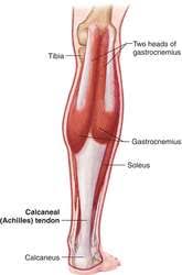 The image identifies the anatomy of the Achilles Tendon and the specific tendons of which it is comprised, Medial and Lateral Heads of Gastrocnemius and Soleus muscles. 