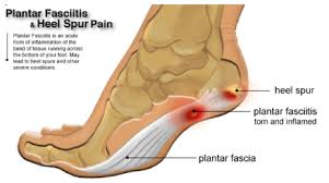 Image represents an illustration of the Plantar Fascia as it originates and inserts onto the heel bone, also illustrated is the location of a Heel Spur. 