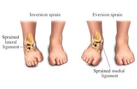 This image reveals some of the anatomy involved in ankle sprains including ligament and bone. It illustrates the difference between Inversion and Eversion Ankle Sprains. 